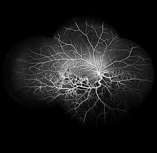 Oclusión de la vena retiniana hemicentral